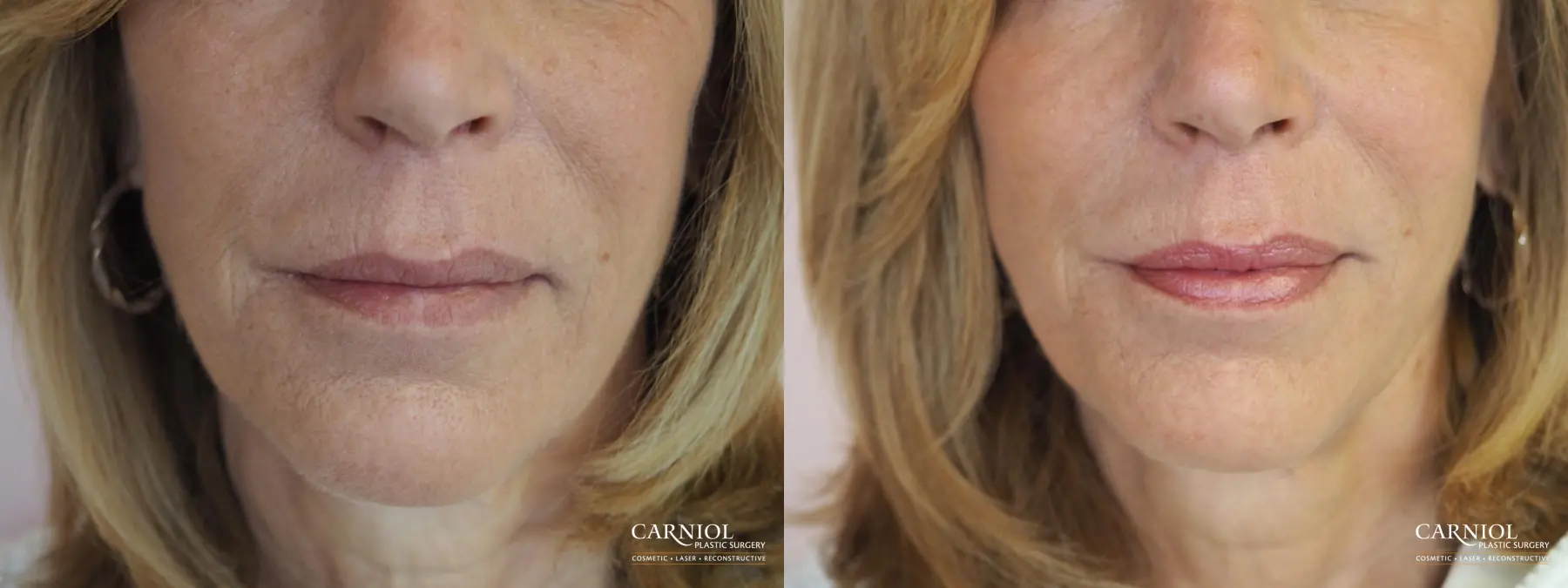 Fillers: Patient 4 - Before and After  