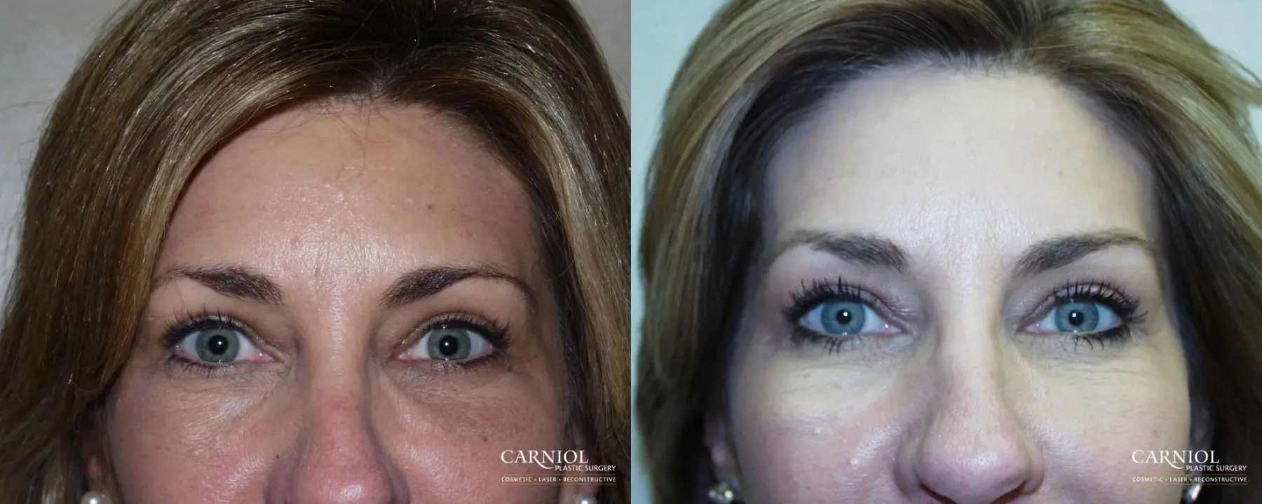 Fillers: Patient 3 - Before and After  