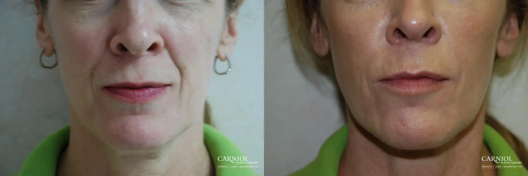 Fillers: Patient 1 - Before and After  