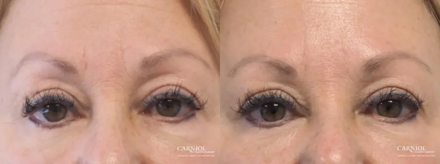 Fillers: Patient 7 - Before and After  