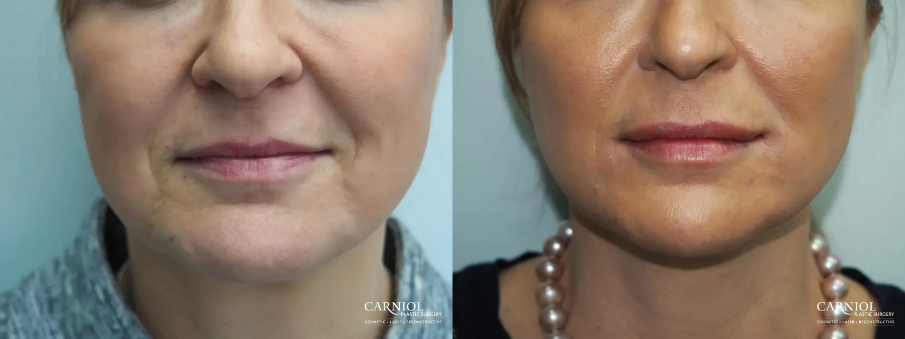 Fillers: Patient 5 - Before and After  