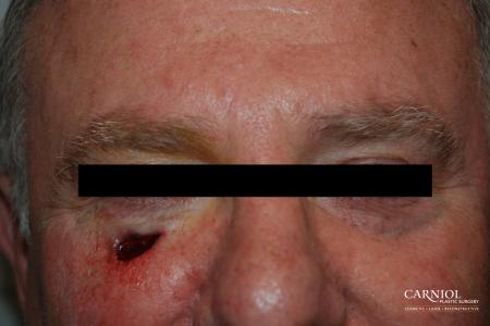 Skin Cancer Reconstruction - Face: Patient 4 - Before Image 1