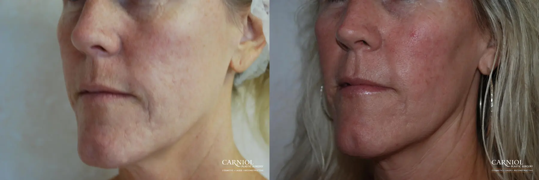 Fractional Resurfacing: Patient 3 - Before and After  