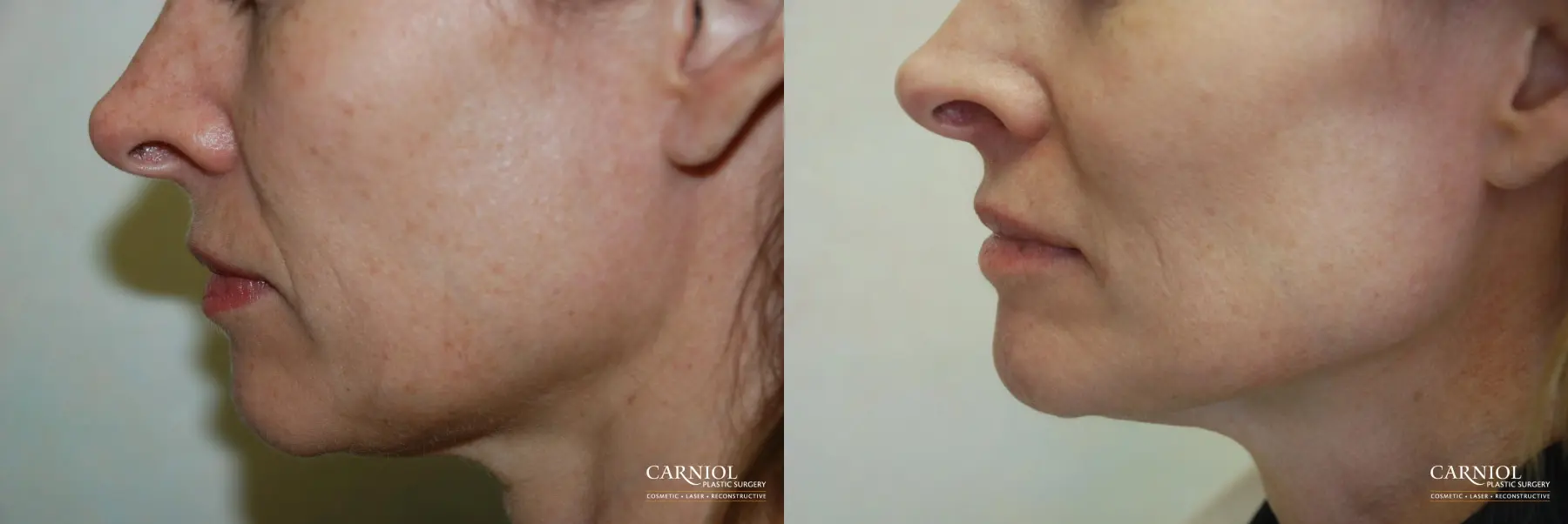 Fractional Resurfacing: Patient 1 - Before and After  
