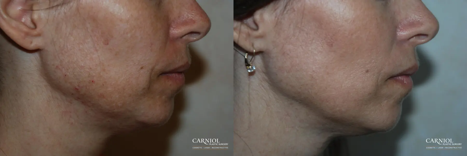 Fractional Resurfacing: Patient 2 - Before and After  