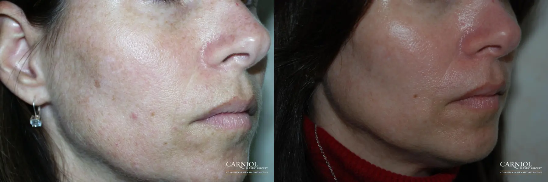 Fractional Resurfacing: Patient 4 - Before and After  
