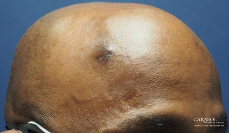 Mole/Age Spot Removal: Patient 3 - After Image 1