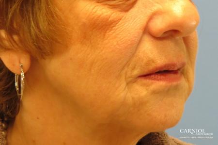 Non-Surgical Facelift: Patient 1 - After Image 2