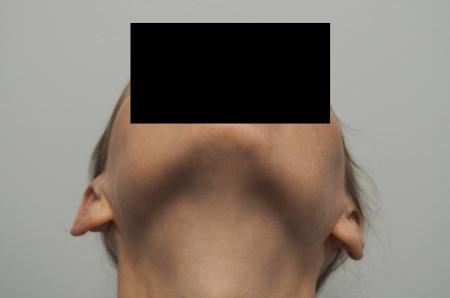 Otoplasty: Patient 3 - After Image 2