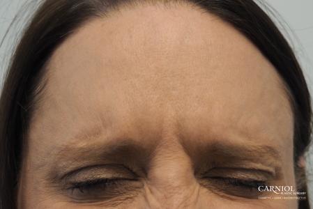 BOTOX® Cosmetic: Patient 4 - After Image 3