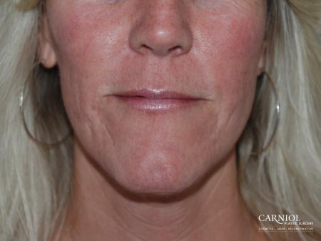 Scar Revision: Patient 2 - After Image 1