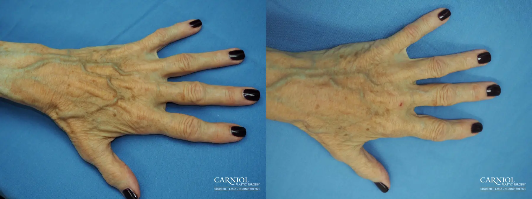 Radiesse Hand Rejuvenation - Before and After  