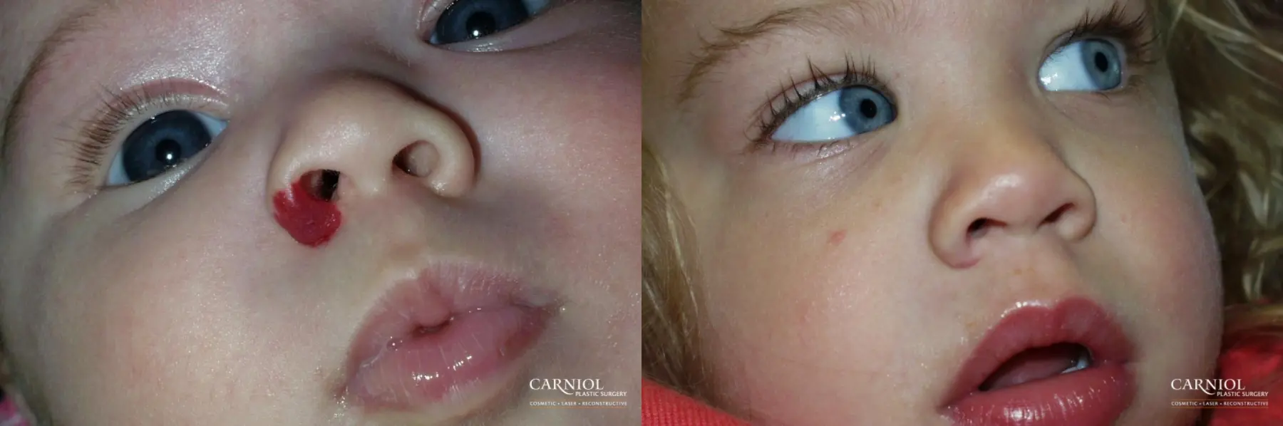Hemangioma: Patient 2 - Before and After  