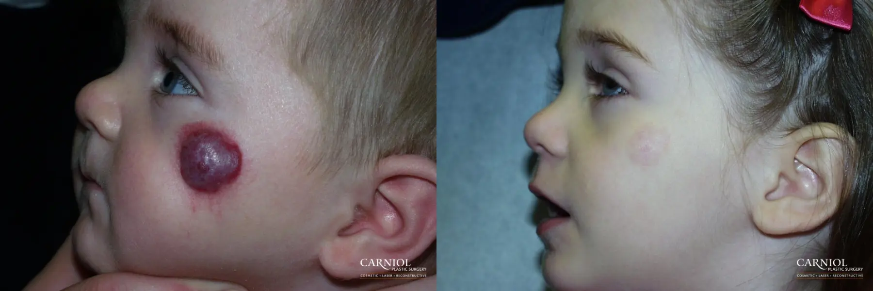 Hemangioma: Patient 1 - Before and After  