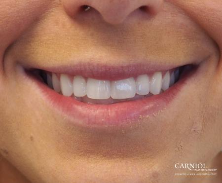 Lip Augmentation: Patient 7 - Before Image 1