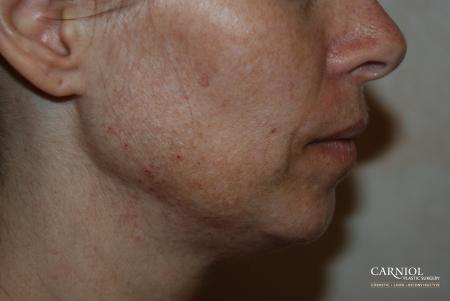 Fractional Resurfacing: Patient 2 - Before Image 1