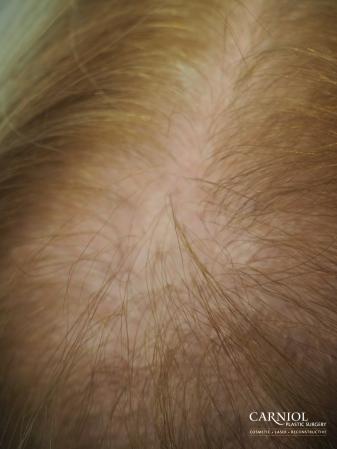 Nonsurgical Hair Restoration: Patient 1 - After Image 1