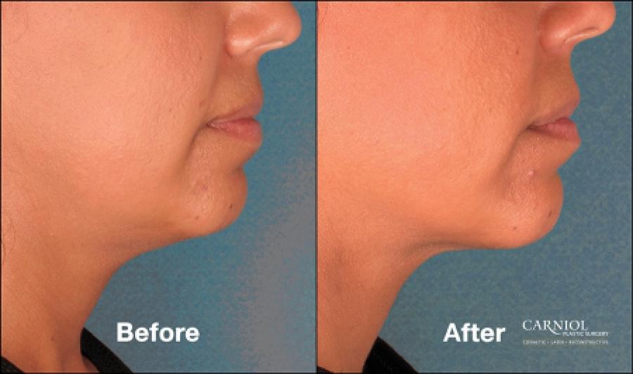 Double Chin, Kybella: Patient 3 - Before and After Image 1