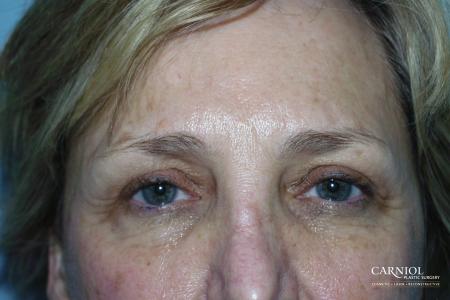 Eyelid Lift: Patient 4 - After Image 1