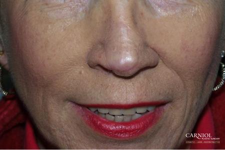 Skin Cancer Reconstruction - Face: Patient 2 - After Image 1