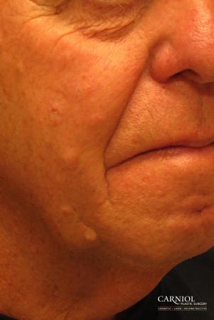 Mole/Age Spot Removal: Patient 2 - After Image 2