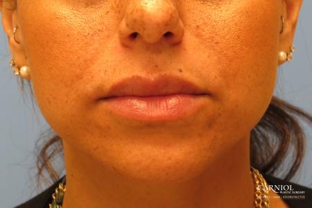 Scar Revision: Patient 3 - After Image 1