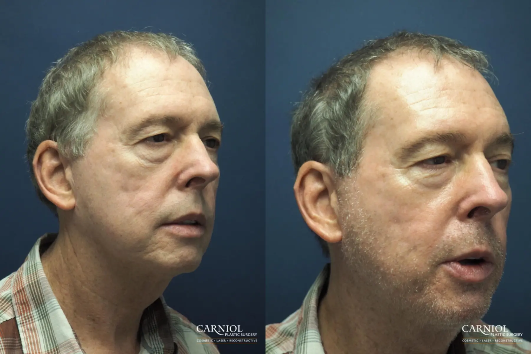 Laser: Patient 3 - Before and After  