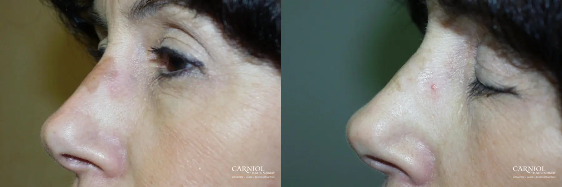 Laser Skin Resurfacing - Face: Patient 1 - Before and After  
