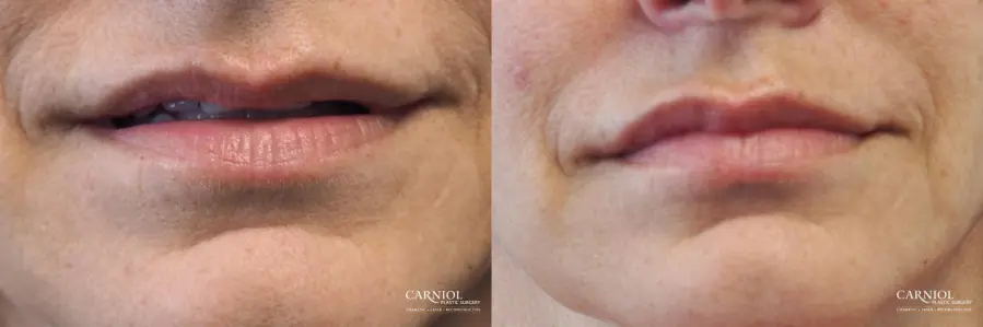 Lip Fillers Chatham Westfield Short Hills New Providence - Before and After