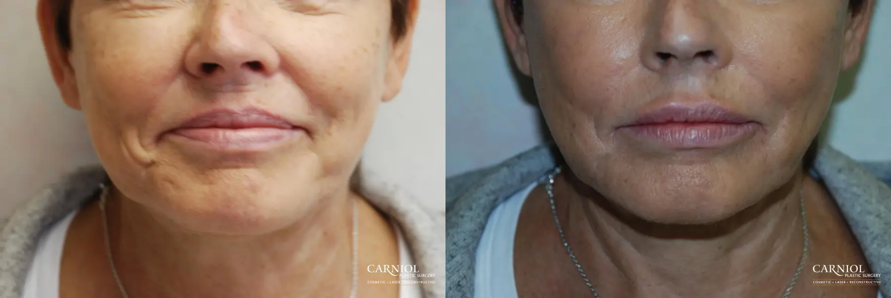 Lip Augmentation: Patient 4 - Before and After 1