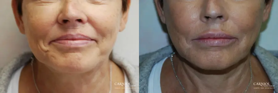Lip Augmentation: Patient 4 - Before and After  