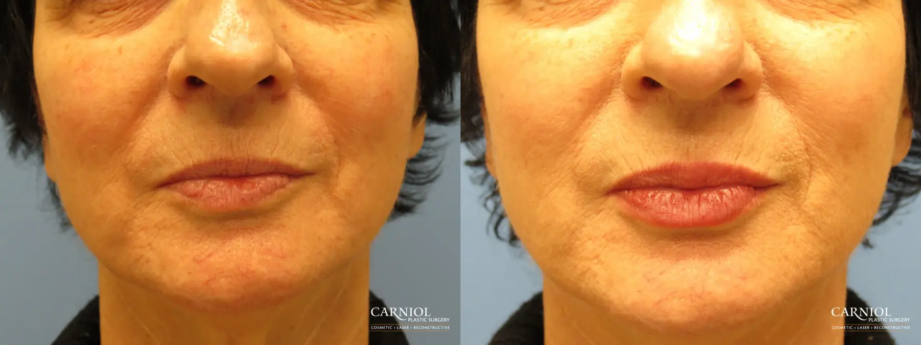 Lip Augmentation: Patient 6 - Before and After 1