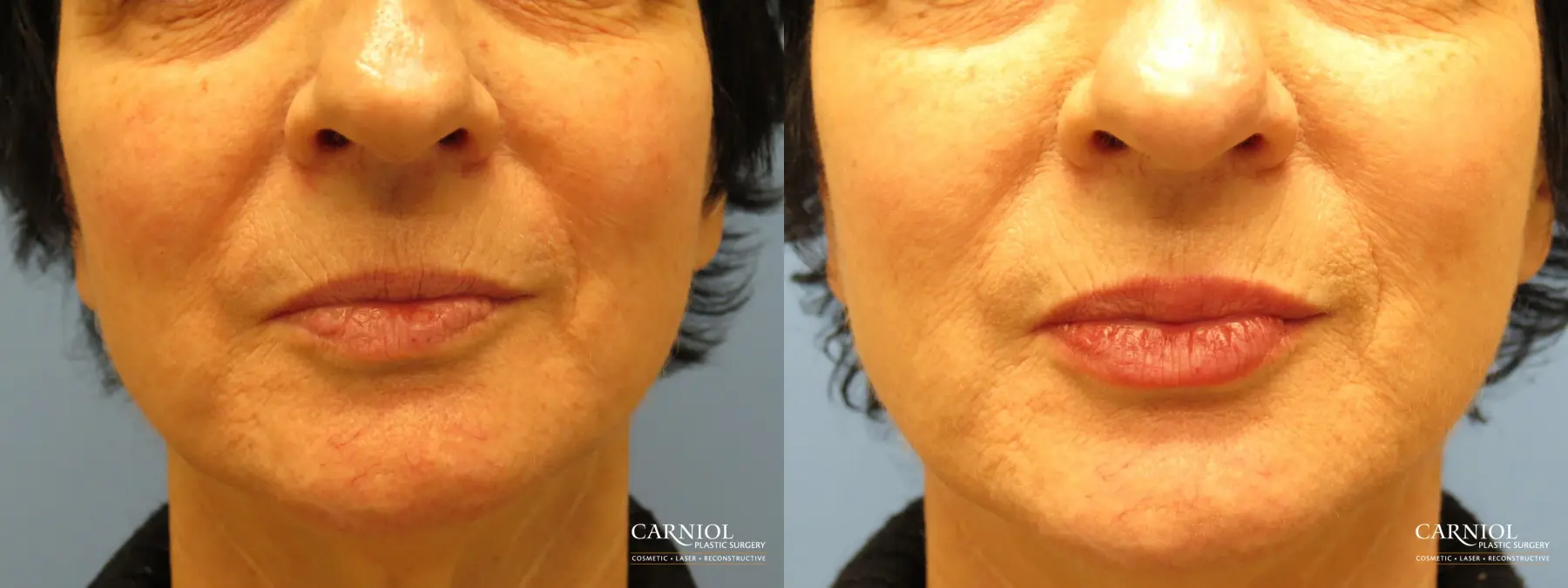 Lip Augmentation: Patient 6 - Before and After  