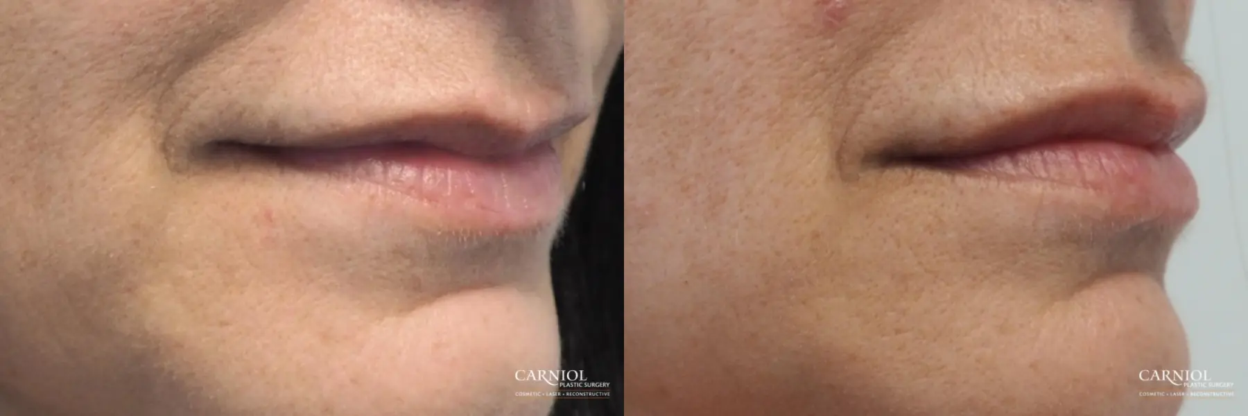 Lip Fillers Chatham Westfield Short Hills New Providence - Before and After 2