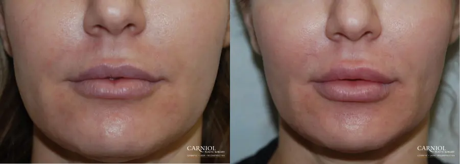 Lip Augmentation: Patient 5 - Before and After  