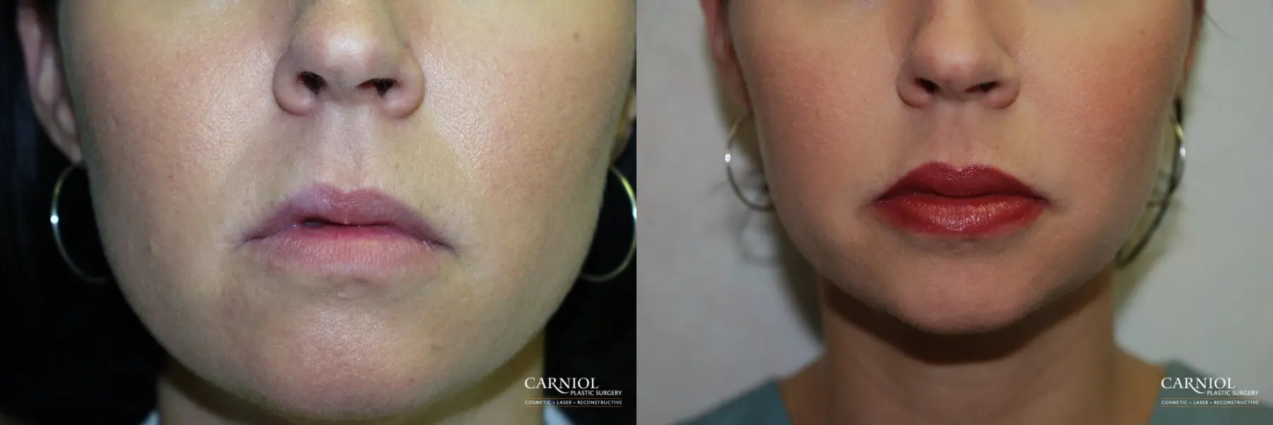 Lip Augmentation: Patient 3 - Before and After  