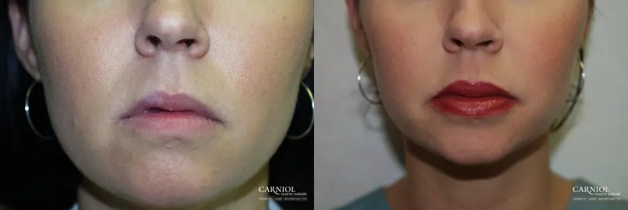 Lip Augmentation: Patient 3 - Before and After  