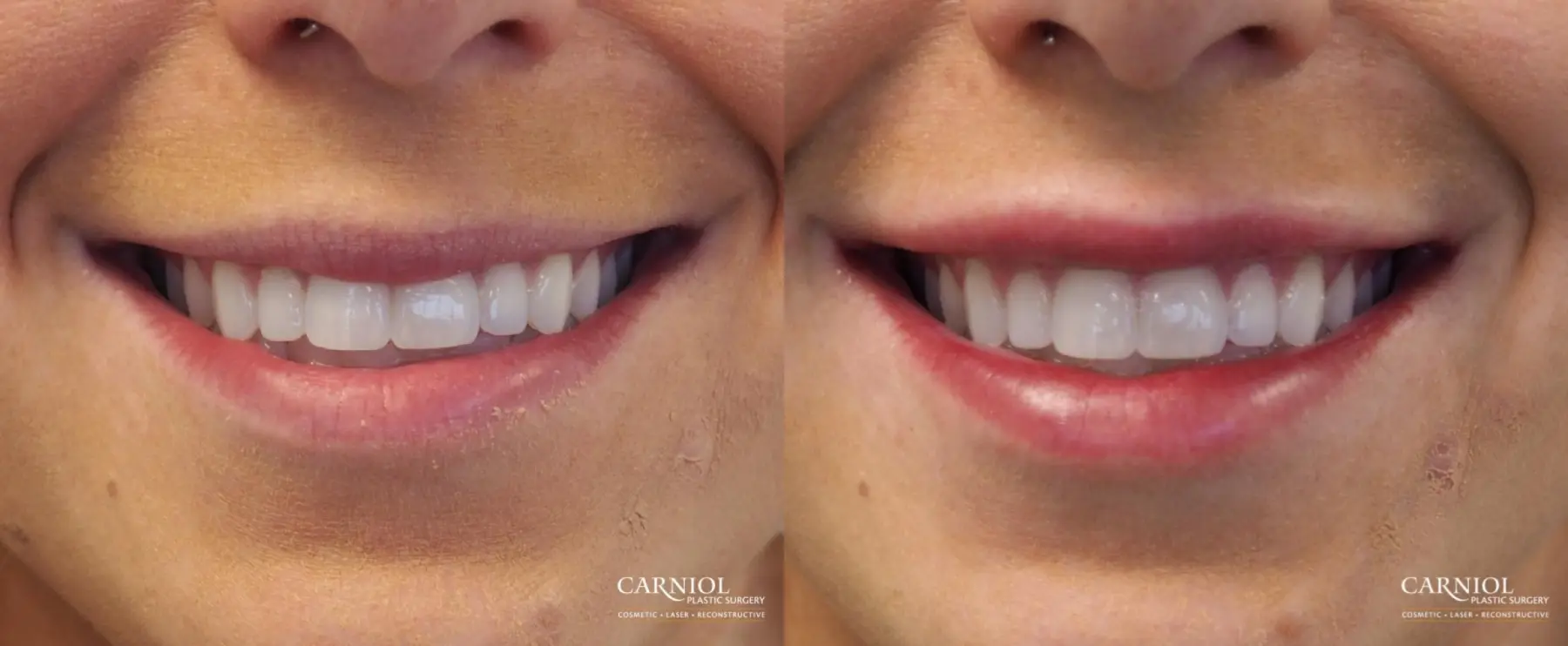 Lip Augmentation: Patient 7 - Before and After 1