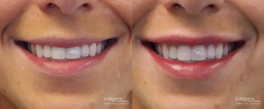 Lip Augmentation: Patient 7 - Before and After  