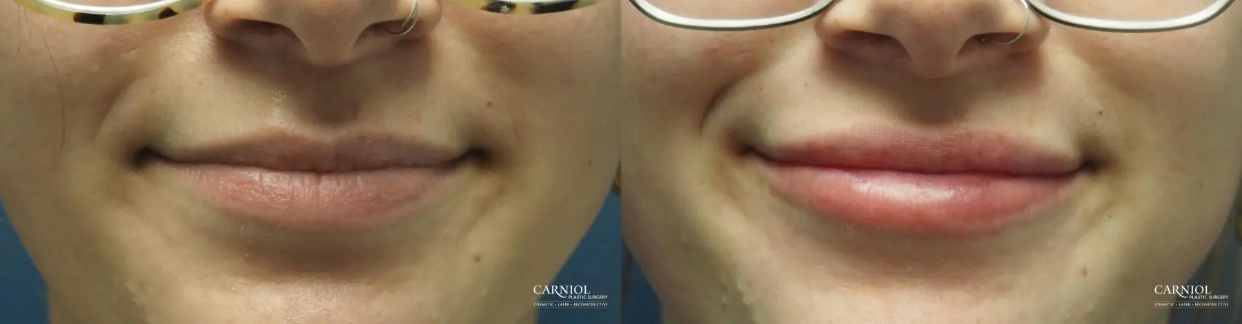 Lip Filler: Patient 1 - Before and After  