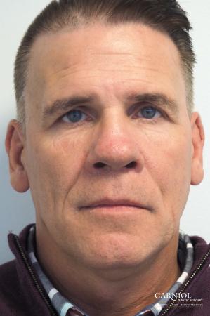 Non-Surgical Facelift: Patient 2 - Before Image 2