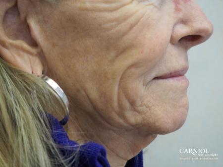 Facial Tightening: Patient 6 - Before Image 1