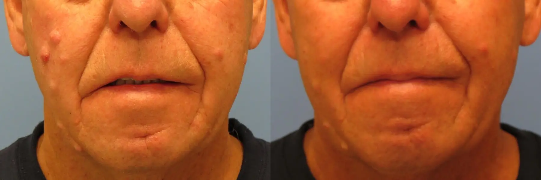 Mole Or Age Spot Removal: Patient 2 - Before and After 1
