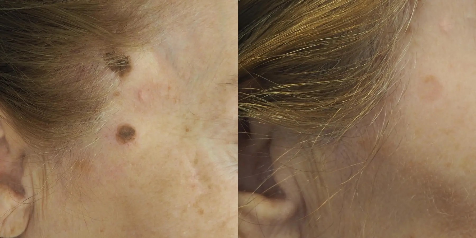 Mole Or Age Spot Removal: Patient 1 - Before and After  