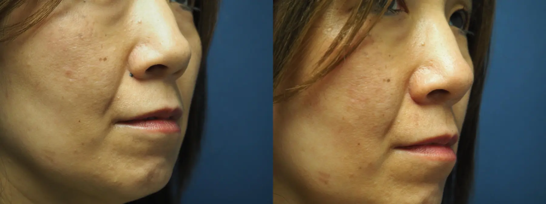 Mole Or Age Spot Removal: Patient 4 - Before and After  