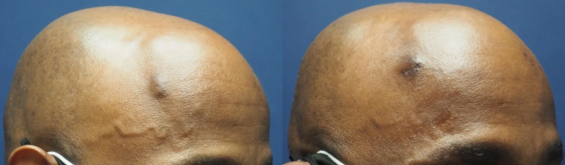 Mole Or Age Spot Removal: Patient 3 - Before and After 1