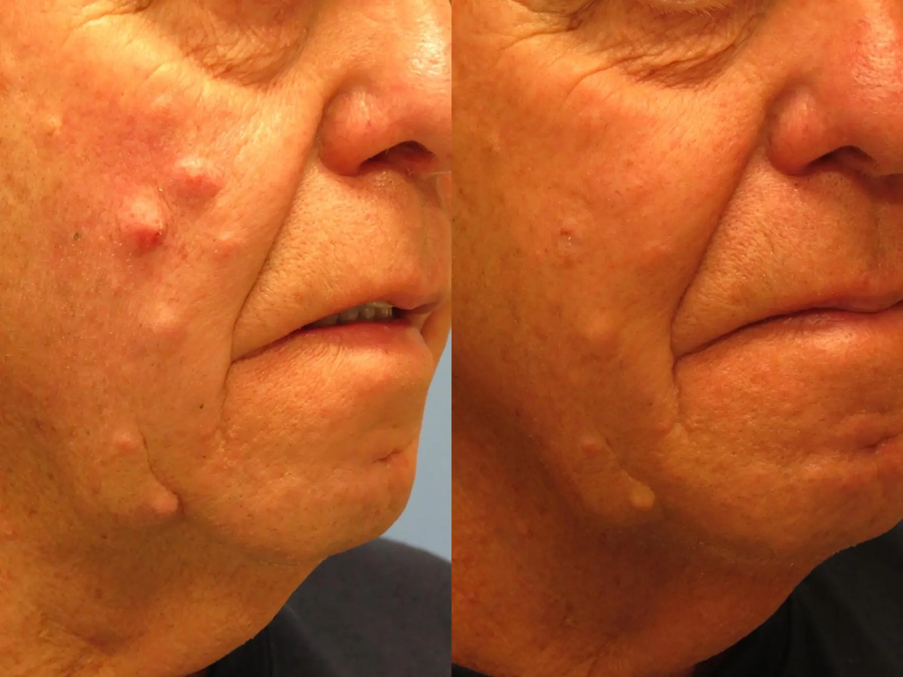 Mole Or Age Spot Removal: Patient 2 - Before and After 2