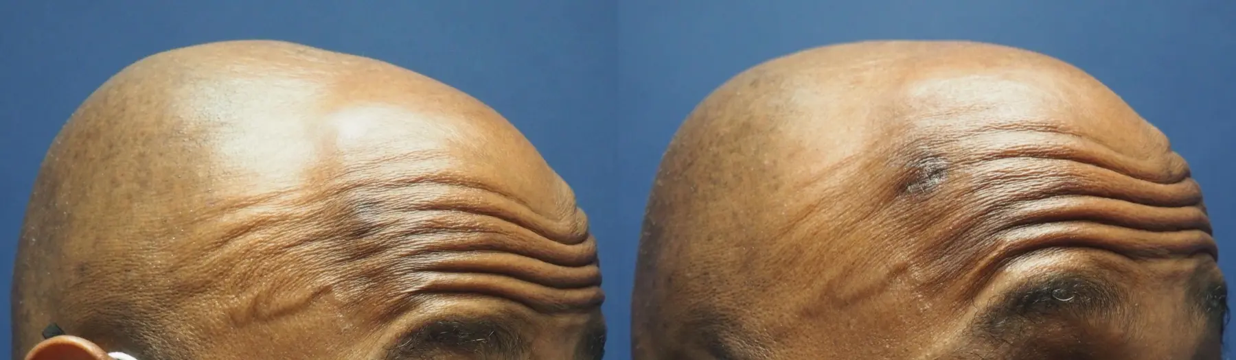 Mole Or Age Spot Removal: Patient 3 - Before and After 2