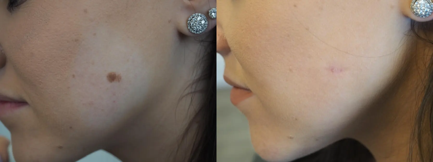 Mole Or Age Spot Removal: Patient 5 - Before and After  