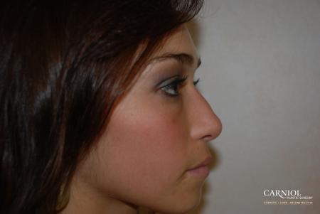 Rhinoplasty: Patient 2 - After Image 1